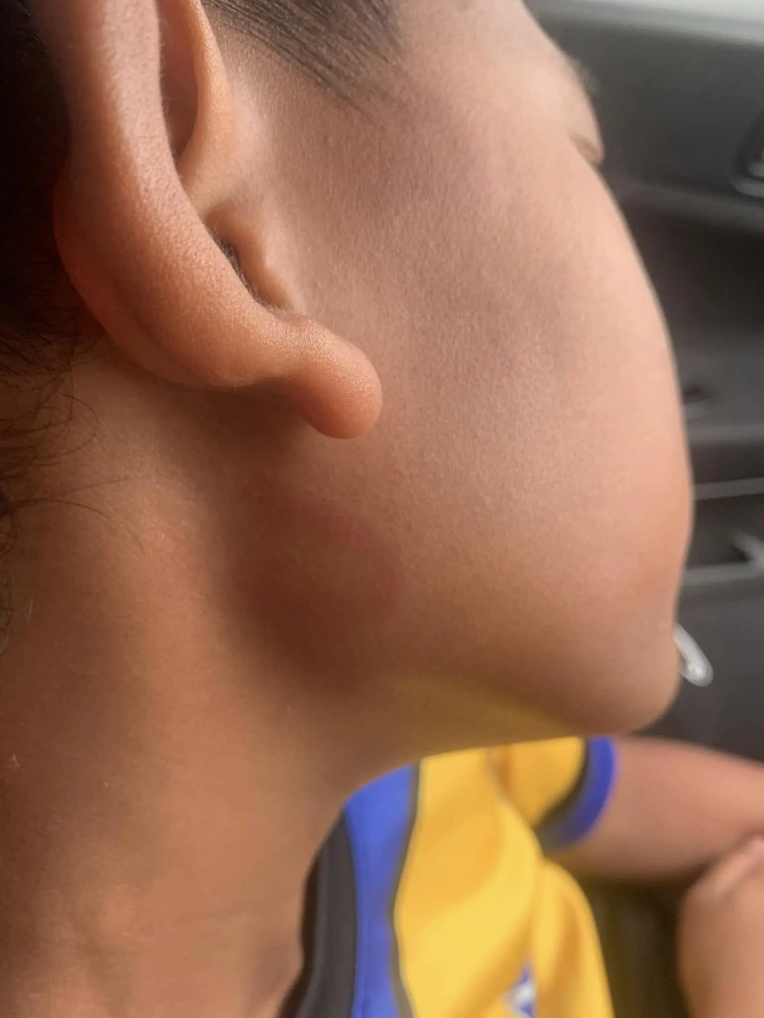 11yo swell after being slap