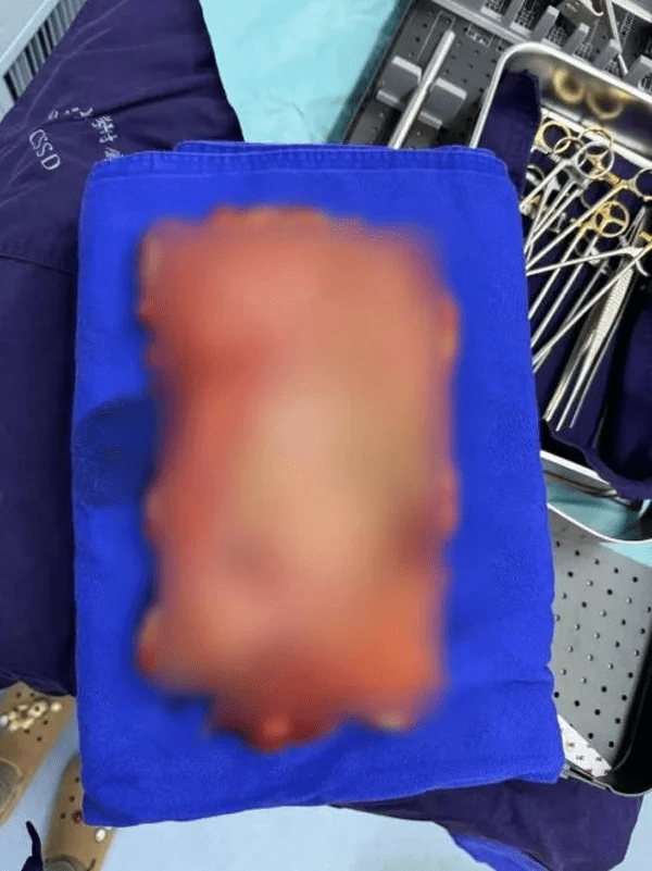 5kg of food removed from stomach