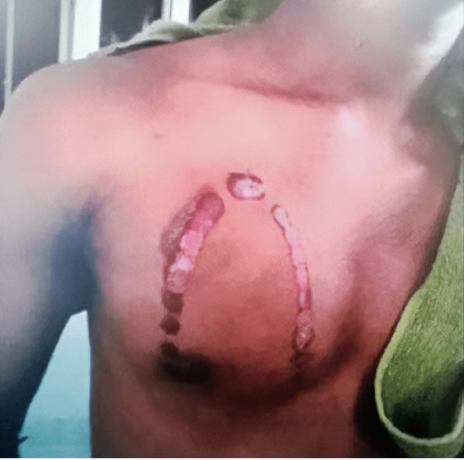 Another UPNM Cadet Allegedly Burnt With Steam Iron, Investigations Underway