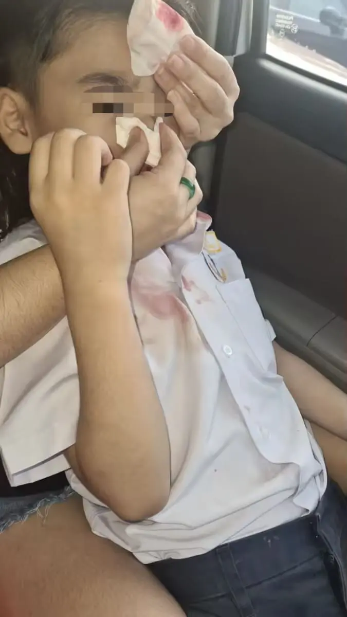 8yo M'sian boy suffering from nosebleeds