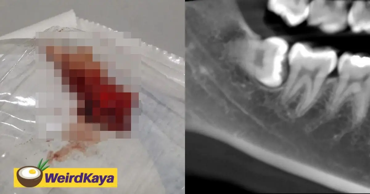 Just went for a wisdom teeth extraction and here are 6 tips for you