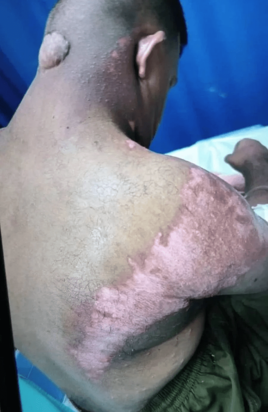 Burn wounds on man with Down Syndrome's body