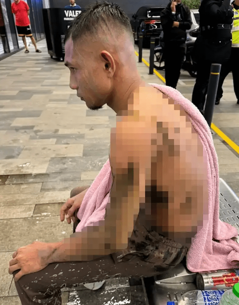 Faisal Halim injured from acid attack