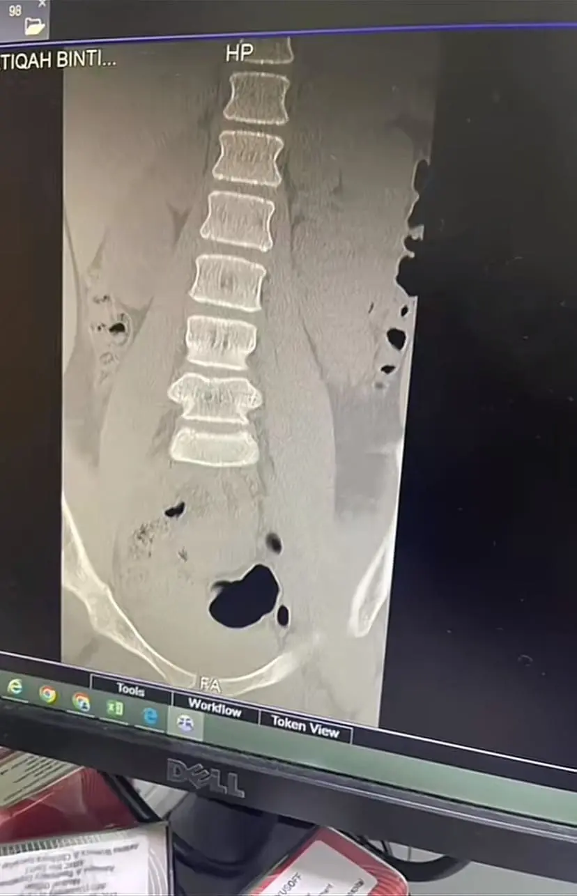 Back bone x-ray scan