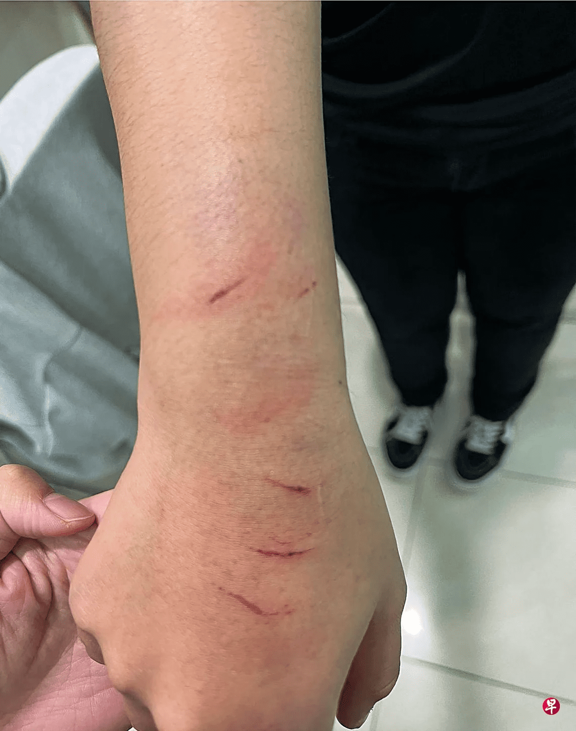 Girl's hand injured by caning