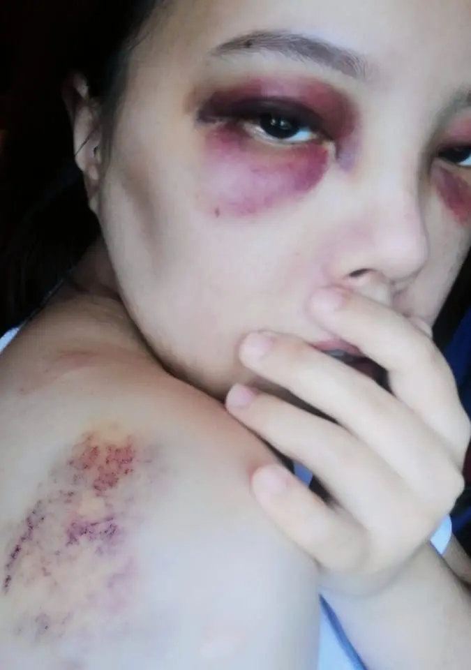 Ai FM DJ Shuleen's body and eyes badly bruised