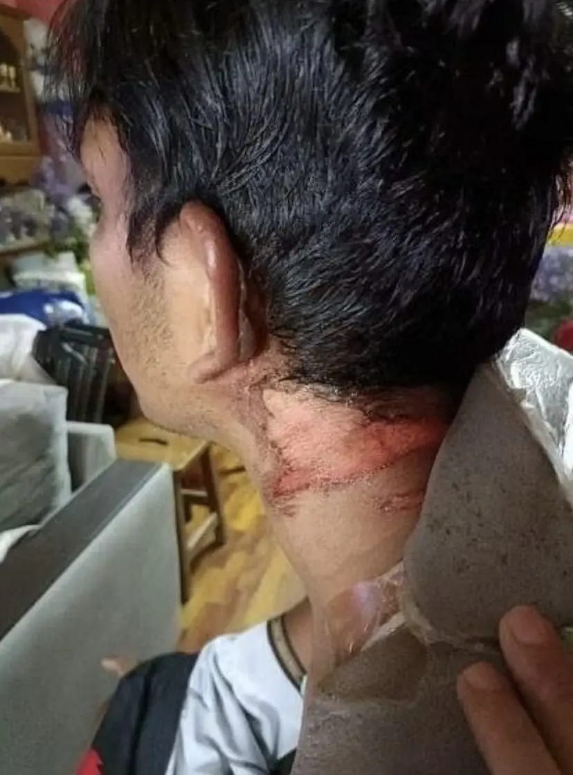 Indonesian Woman Travels To Singapore To Injure M'sian Husband Who Asked For Divorce With Hot Water