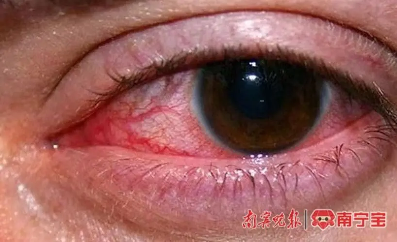 China Man Contracts Gonorrhoea After Using Hotel Towel To Wipe His Face During A Business Trip