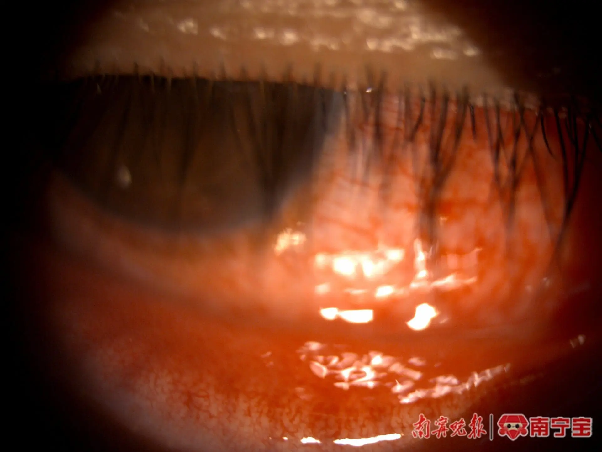 China Man Contracts Gonorrhoea After Using Hotel Towel To Wipe His Face During A Business Trip