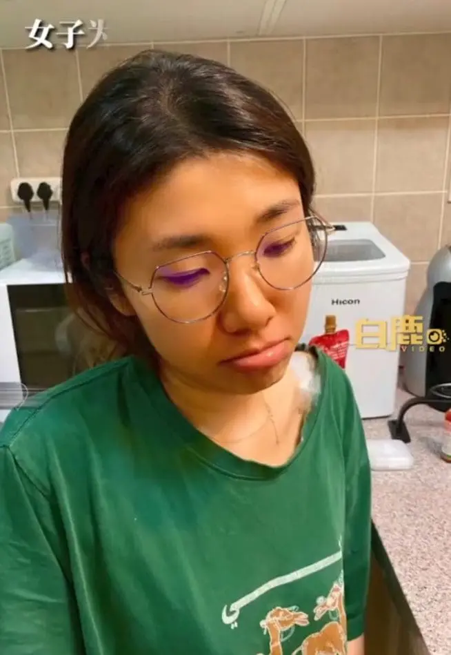 Woman's Skin Turns Orange After She Ate Carrots For 3 Months To Lose Weight