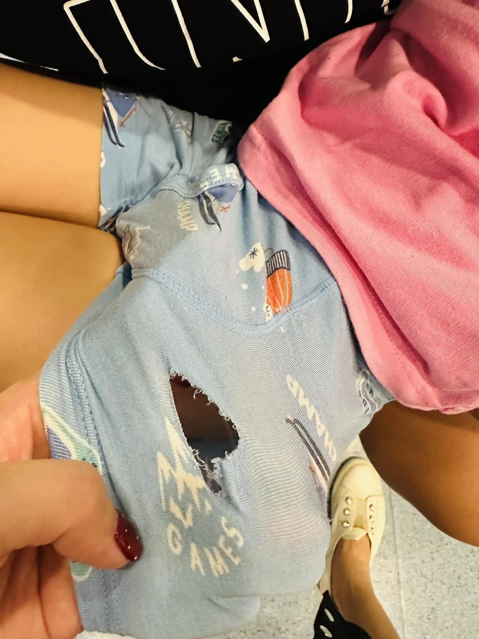 Hole left in 4yo boy's pants after he was bitten by dog