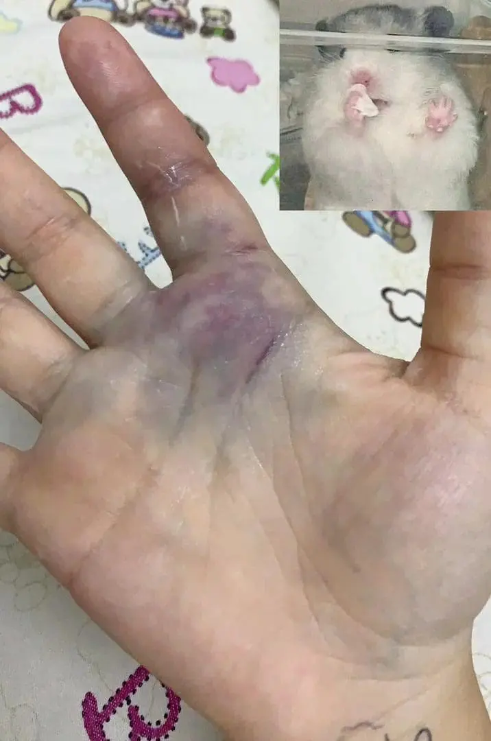 China student's bruised hand after she was attacked by Grab driver in Kuantan