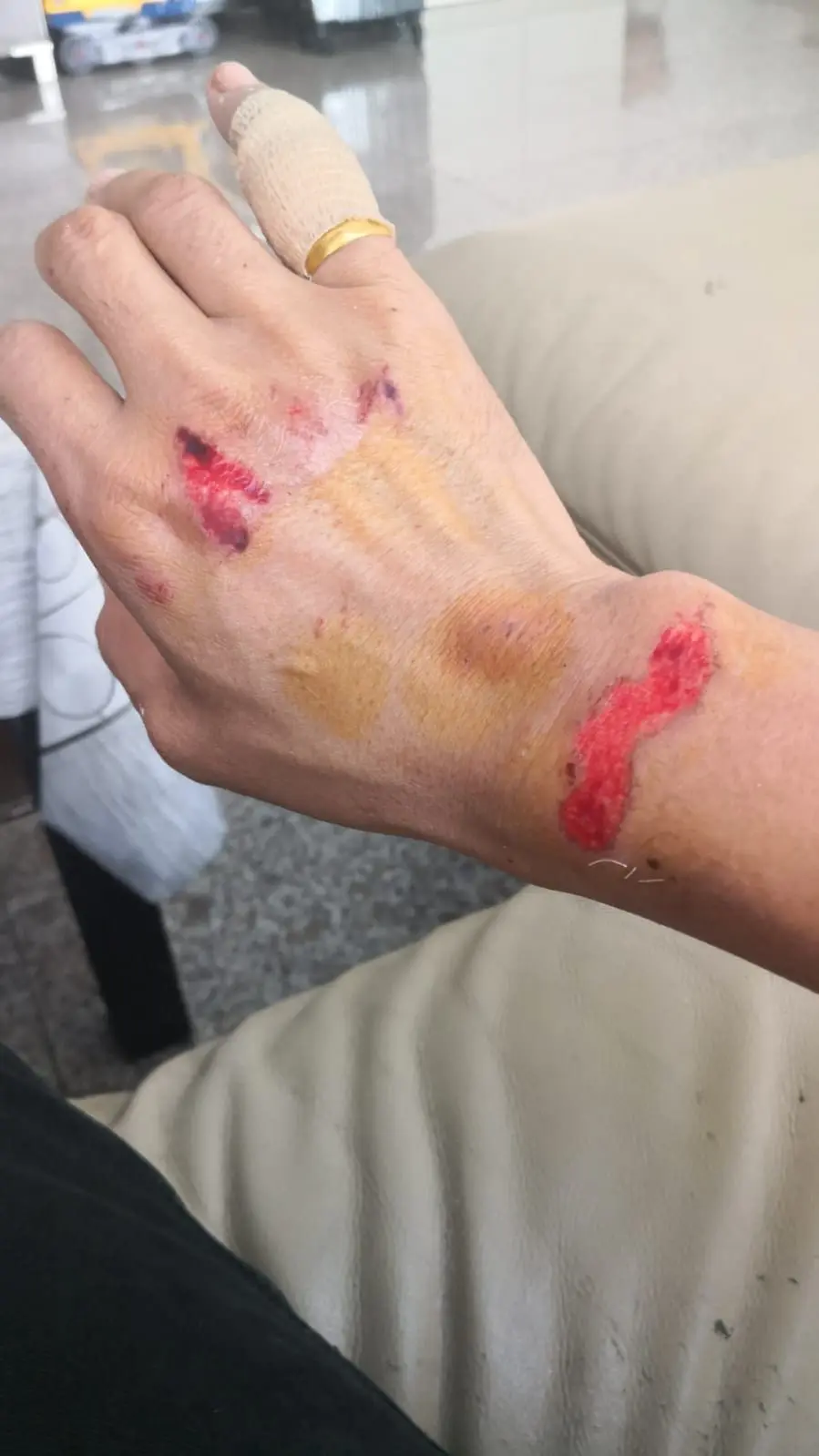 SG man suffers injuries to his wrist while rescuing son from kidnappers