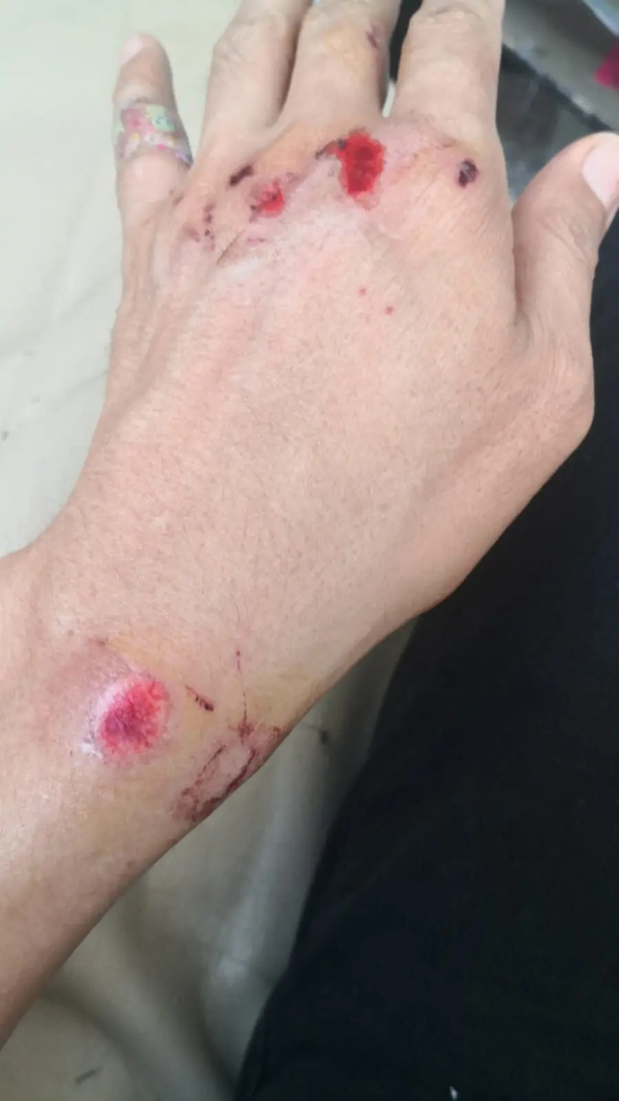 Lin's hand injuries while rescuing son from kidnappers