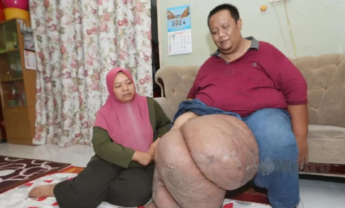 Mohd Zulkifli Zainal showing his swollen right leg