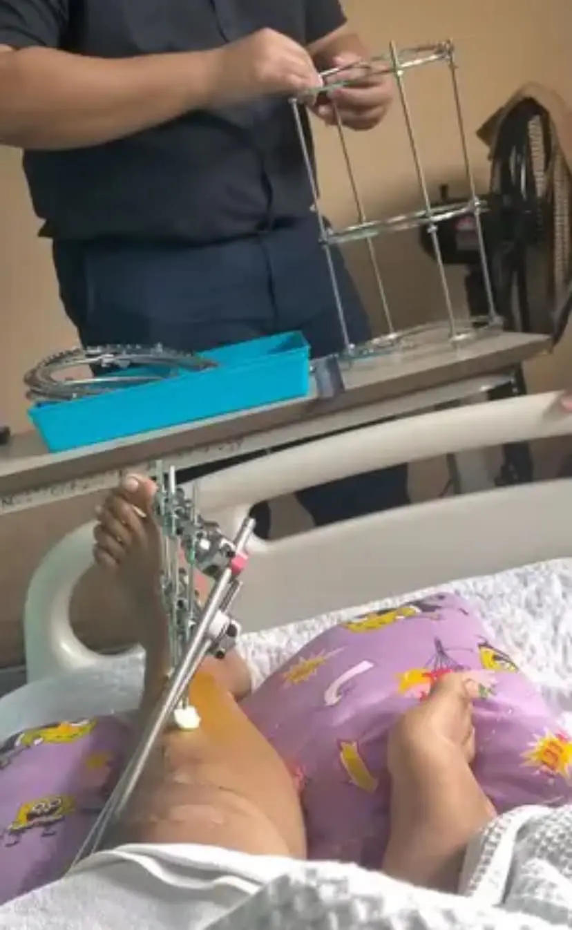 Ilizarov apparatus for leg surgery