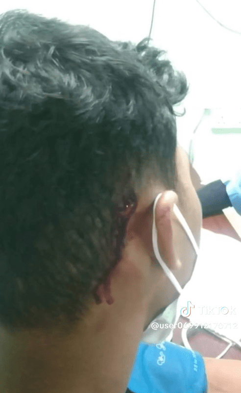 Boy's ear bleeding from exploding firecrackers