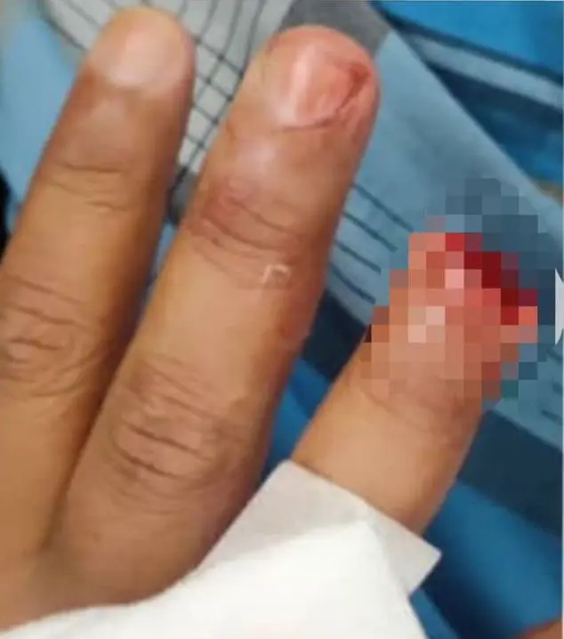 M'sian Police Officer Gets Finger Bitten Off By Man Who Threatened To Splash Acid