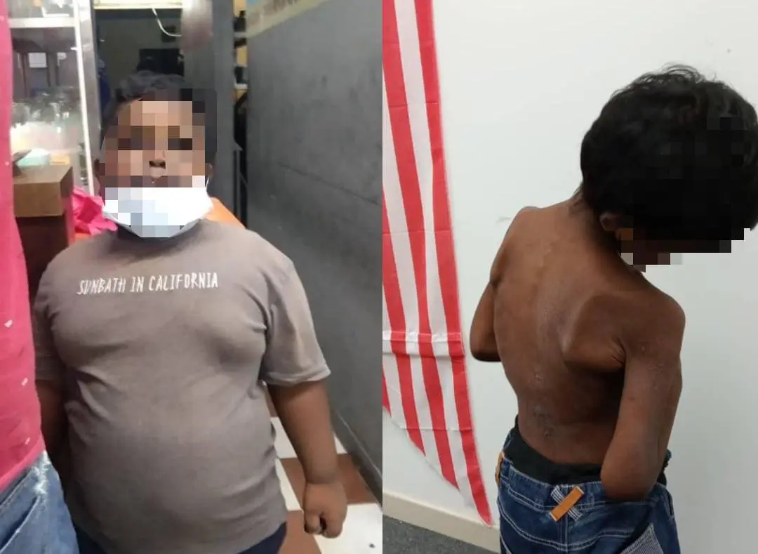 Navin Malaysian boy who got abused (before and after)
