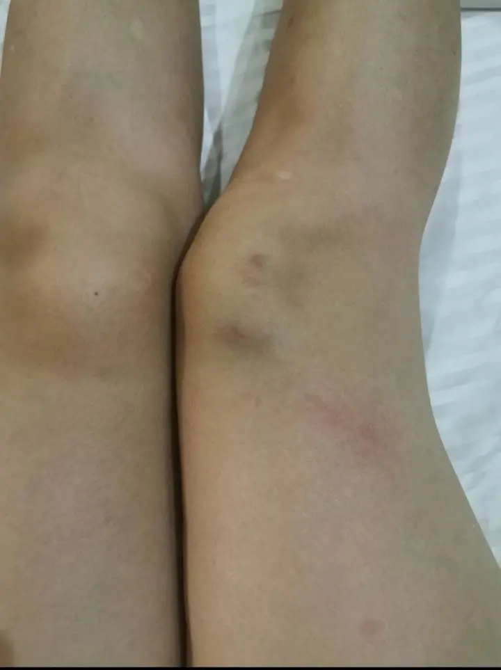 M'sian Woman Suffers Burns After Performer Drops Fire Baton On Her Leg