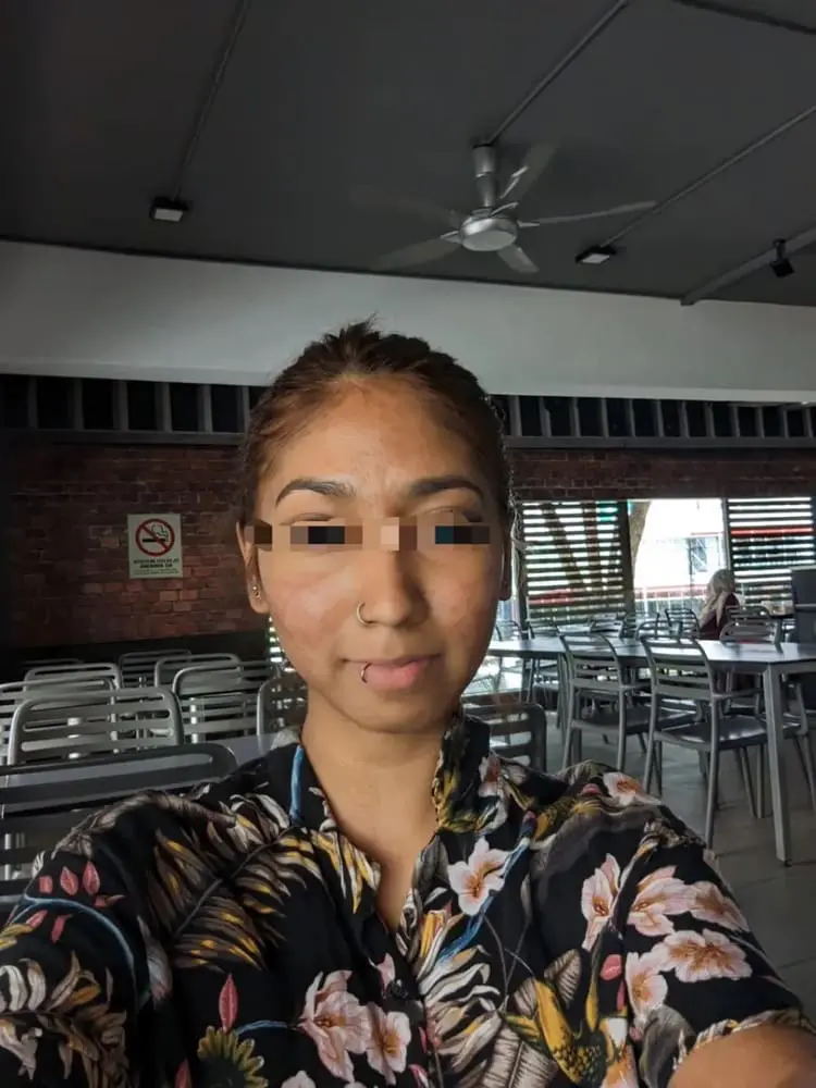 M'sian Woman Claims Face Was Severely Damaged By Laser Treatment, Beauty Clinic Denies Allegations