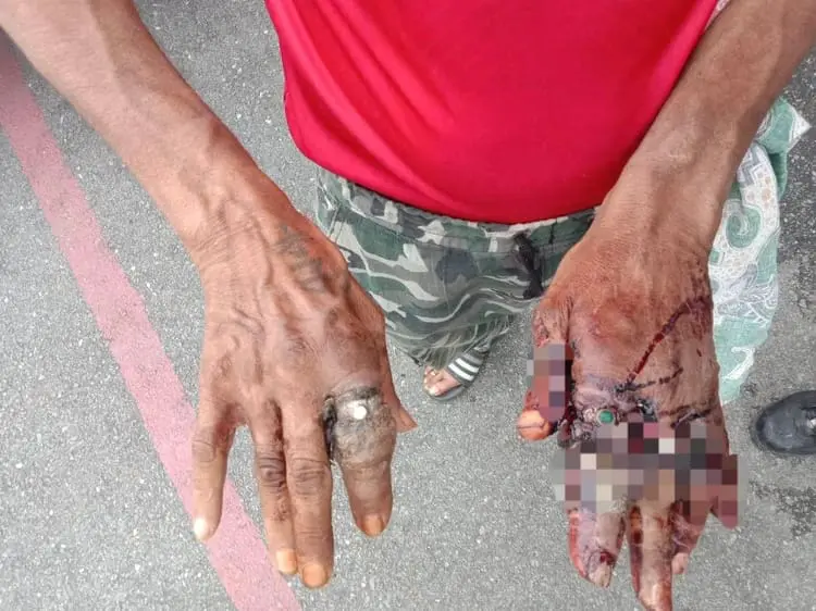 Man's hands become swollen due to rings being worn too tightly