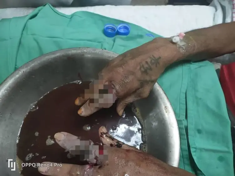 Man's hands being washed with sodium chloride solution