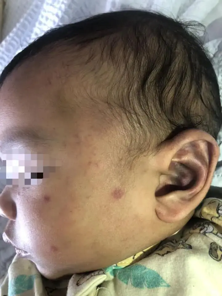 Bruises on Aidin's ears and cheeks