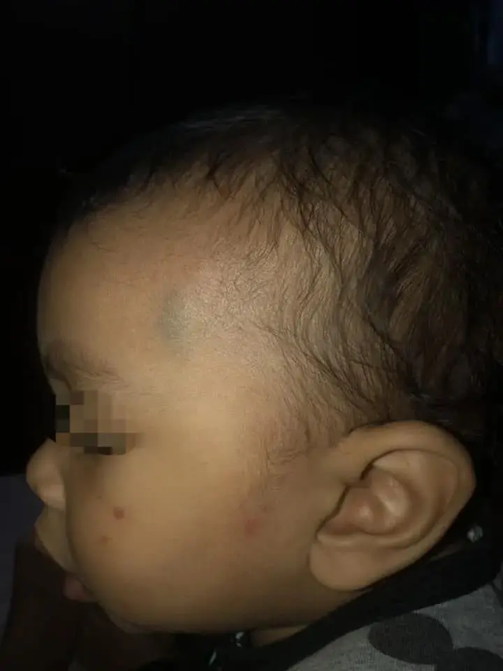 Bruises on Aidin's head