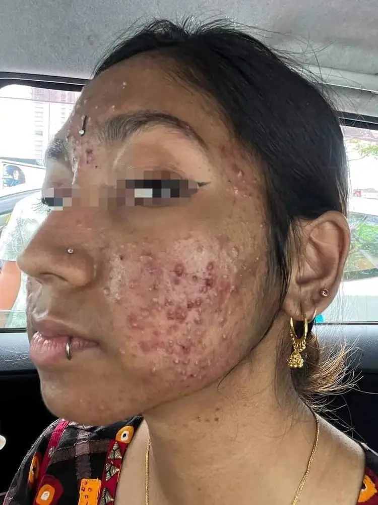 M'sian Woman Claims Face Was Severely Damaged By Laser Treatment, Beauty Clinic Denies Allegations