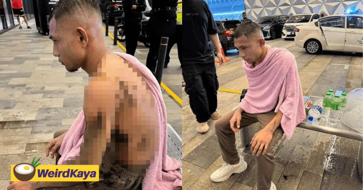 Faisal Halim Now In Critical Condition After Suffering Fourth-Degree Burns From Acid Attack