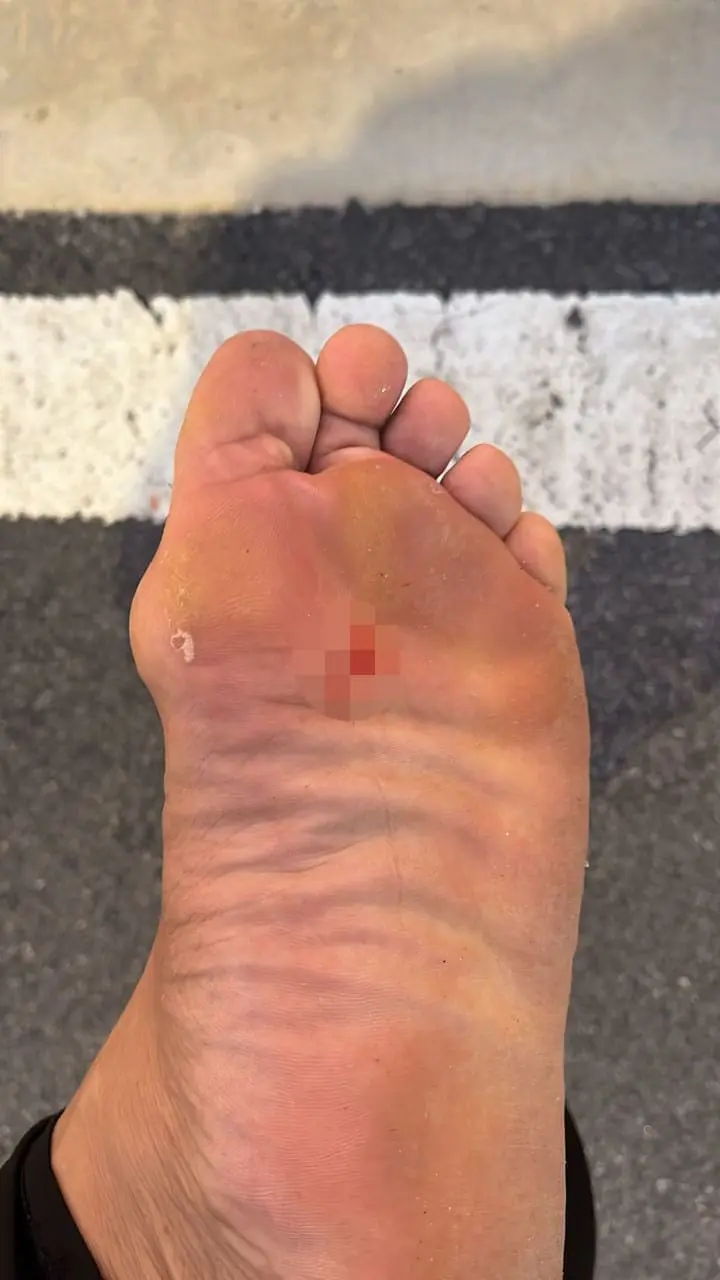 Man's foot bleeding poked by nails while jogging