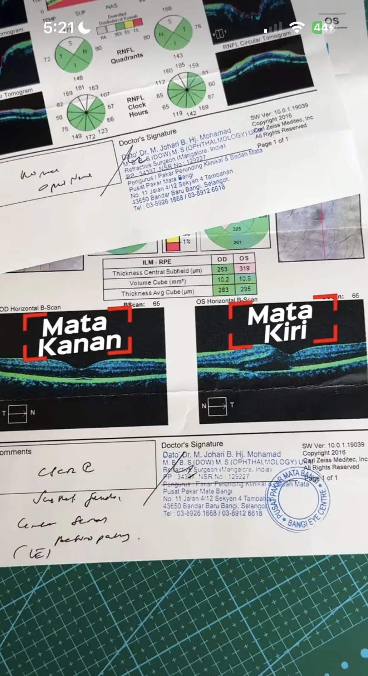 M'sian Man Almost Goes Blind Due To Unmanaged Stress