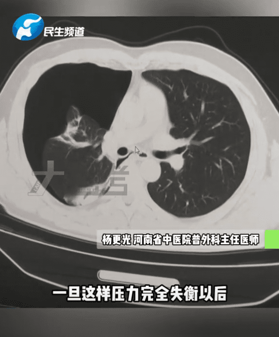 Scan showing China man's collapsed lung