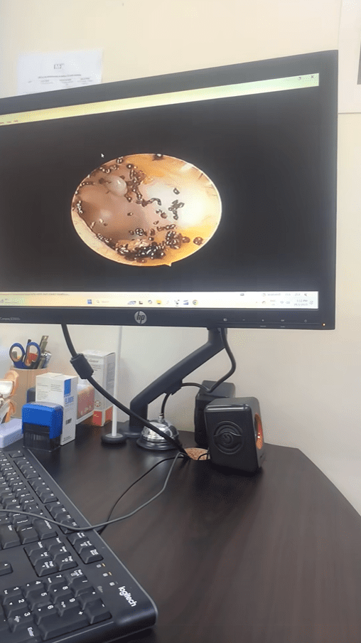 Ticks inside Hayfa's ear