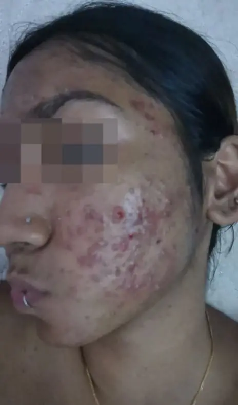 M'sian Woman Claims Face Was Severely Damaged By Laser Treatment, Beauty Clinic Denies Allegations