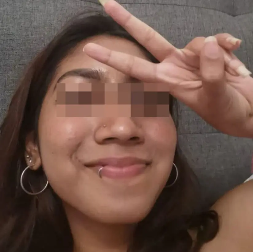 M'sian Woman Claims Face Was Severely Damaged By Laser Treatment, Beauty Clinic Denies Allegations