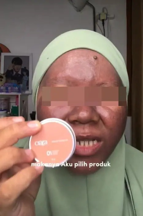 M'sian Woman's Skin Turns Dark After Using Mercury-Containing Whitening Skincare Products