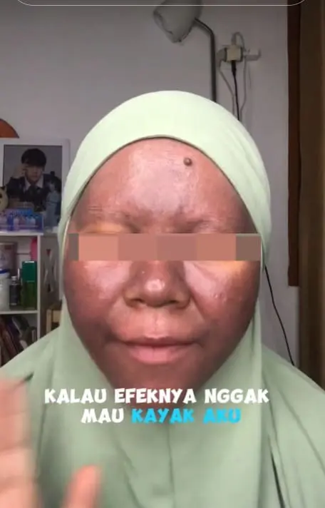 M'sian Woman's Skin Turns Dark After Using Mercury-Containing Whitening Skincare Products
