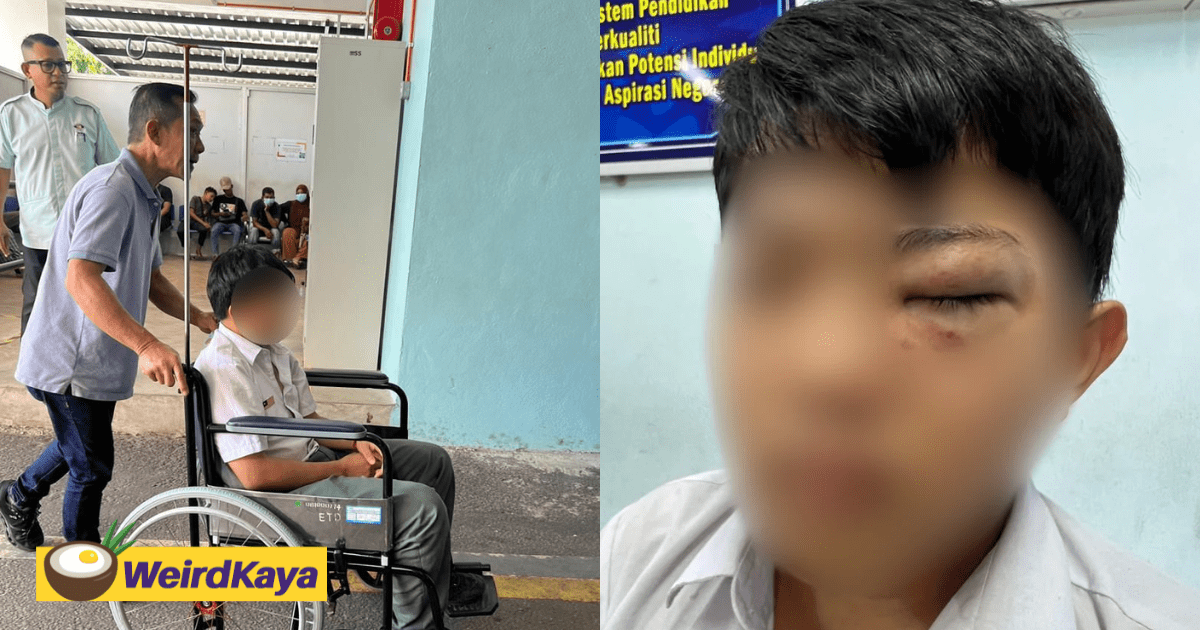 15yo M'sian Boy Beaten By Classmates In Front Of Teacher, Left With Bruised Eye
