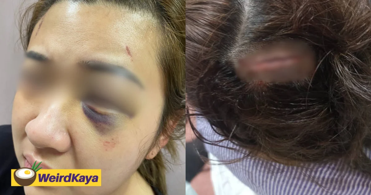 M’sian Woman Left Bruised By BF, Who’s 20 Years Older, After She Reminded Him To Set An Alarm | WeirdKaya