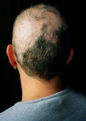 trichotillomania