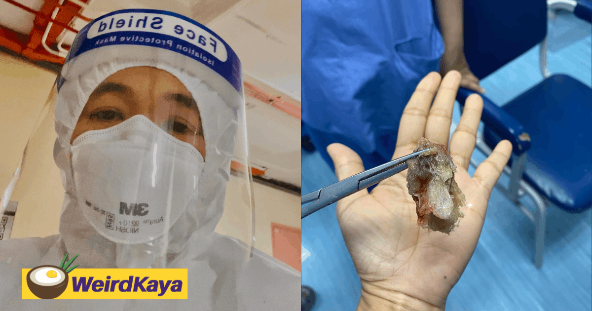 Doctor shares revolting photo of phlegm taken from a young covid-19 patient's throat | weirdkaya