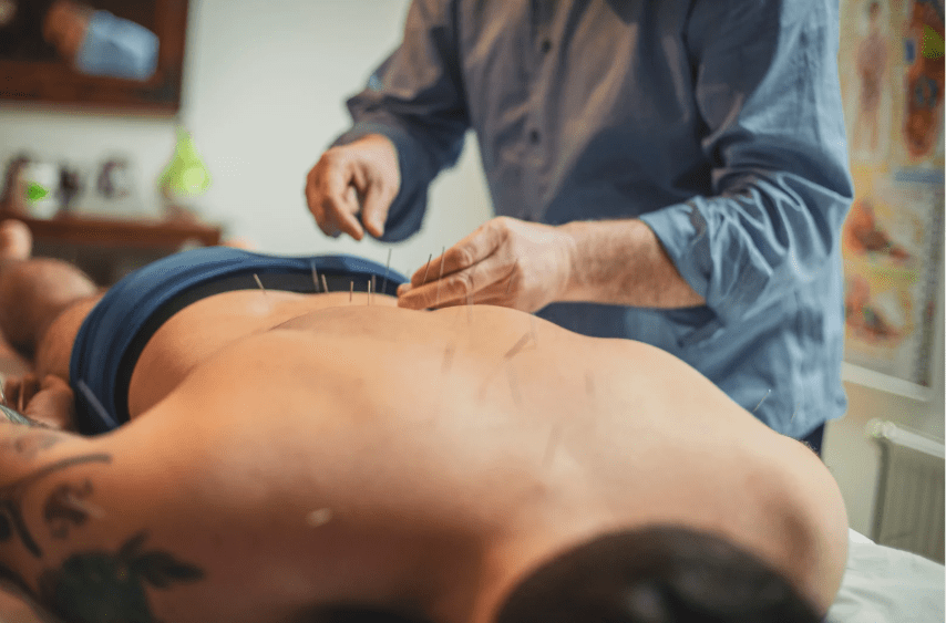 acupuncture treatment