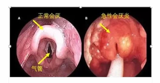 acute epiglottitis