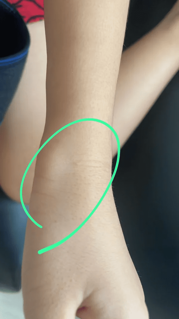 Bruise left on girl's arm due to caning