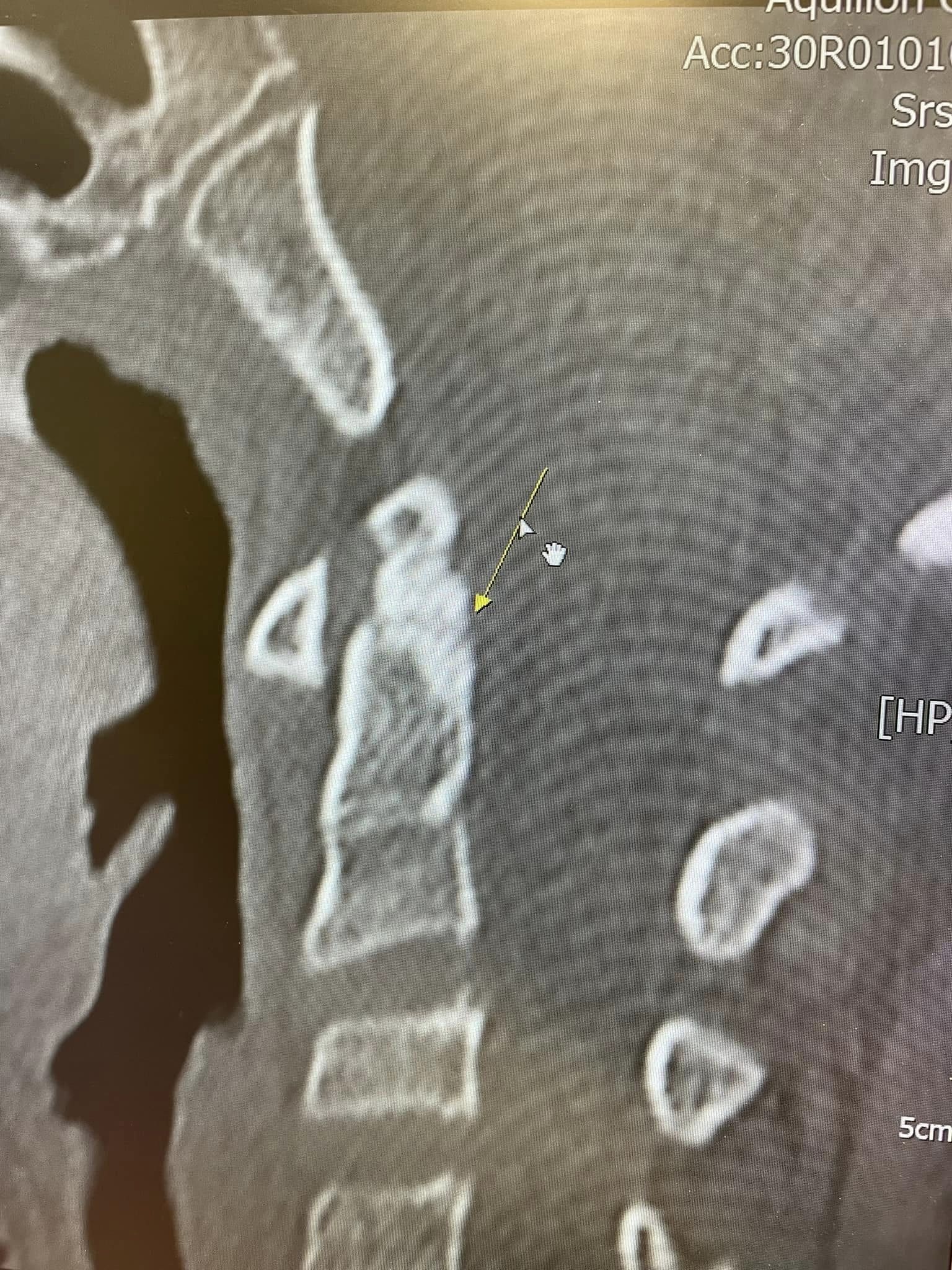 CT scans of the victim