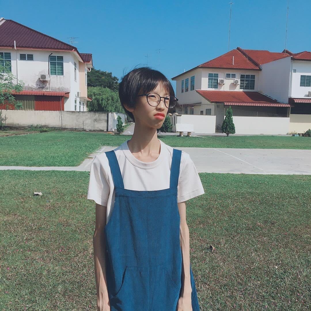 Fion with anorexia