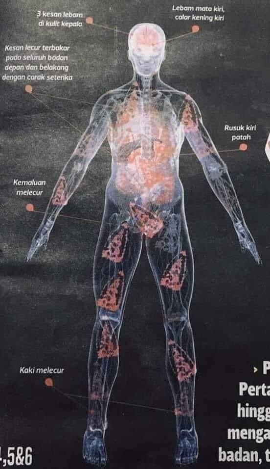 Zulfarhan Osman Zulkarnain post-mortem