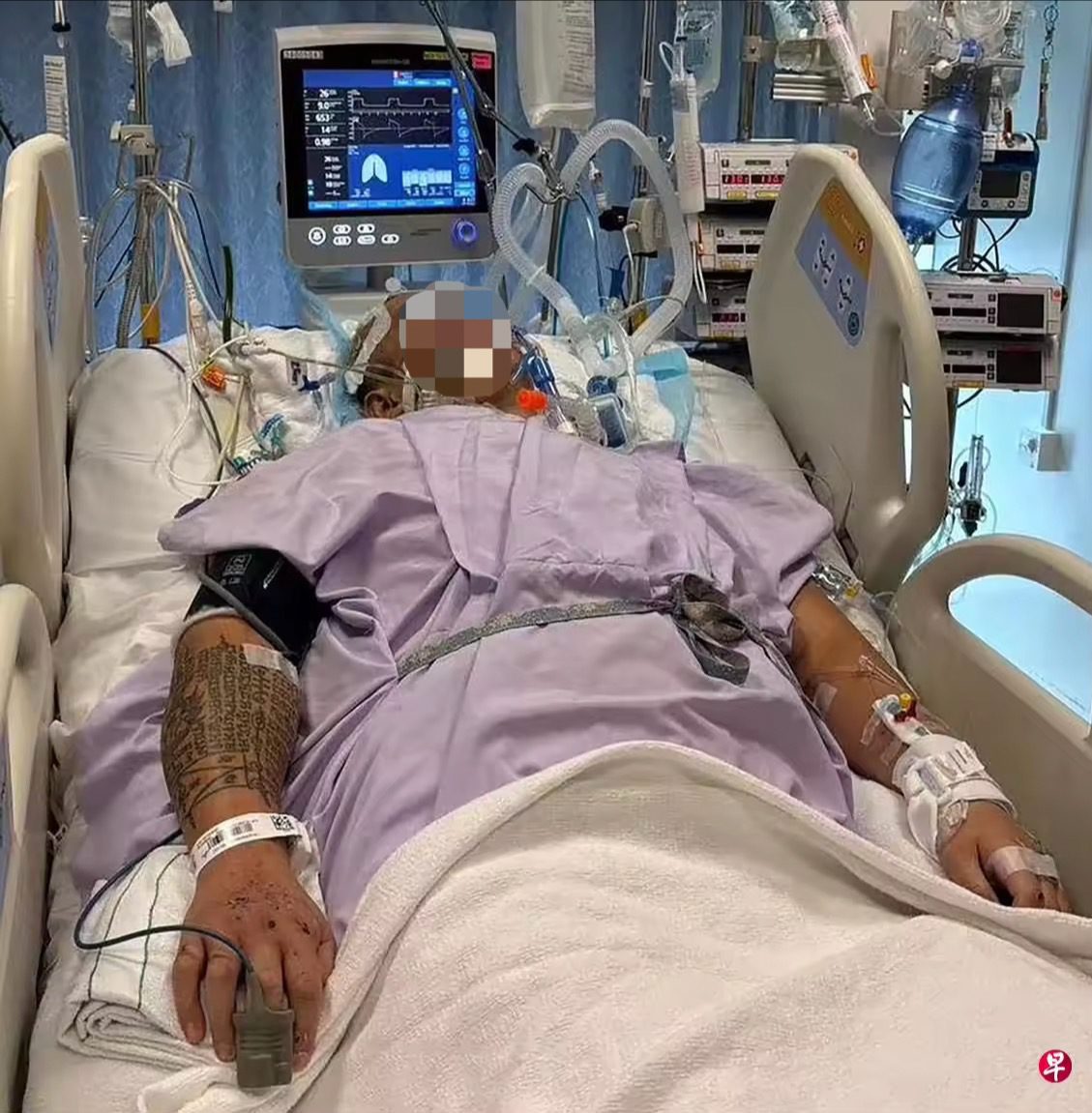 Guo in the ICU